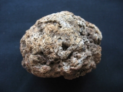 Leiomyoma